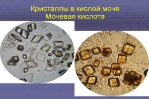 Кристаллы мочевой кислоты в почках