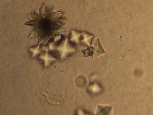 Кристаллы мочевой кислоты в почках