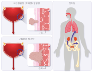 Кровь после мочеиспускания у женщин с болью