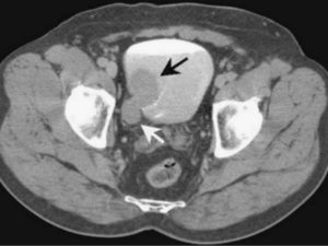Кт почек мочевого пузыря с контрастом