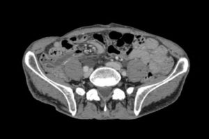 Кт почек мочевого пузыря с контрастом