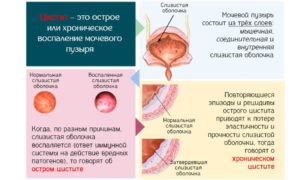 Лечится ли хронический цистит