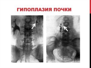 Маленькая почка у взрослого человека