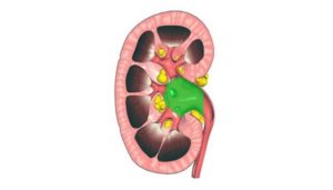 Маленькая почка у взрослого человека
