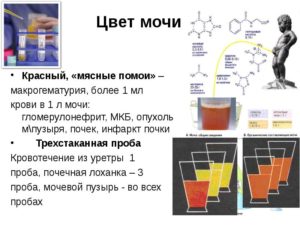 Моча цвета мясных помоев наблюдаются