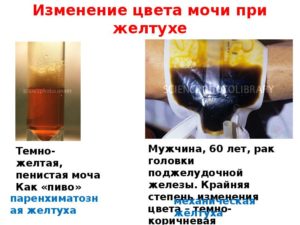 Моча цвета пива отмечается при