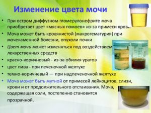 Моча цвета пива отмечается при