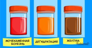 Моча цвета пива отмечается при