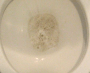 Моча с пеной у мужчин