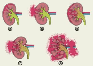 Может ли болеть почка от поднятия тяжести
