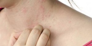 Может ли быть сыпь при заболевании почек