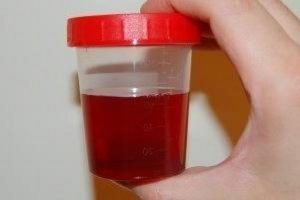 Может ли моча поменять цвет от свеклы