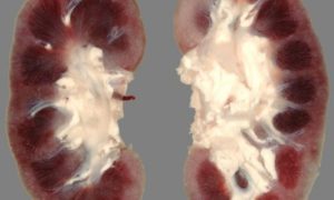 Может ли пиелонефрит вызвать бесплодие