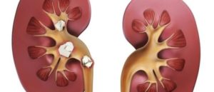 Можно ли греть почки при воспалении