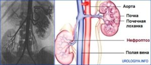 Можно ли поднять почку