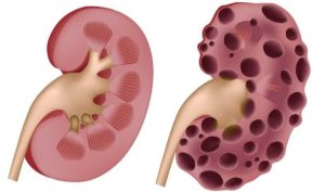 Можно ли при мочекаменной болезни употреблять алкоголь