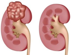 Нарушение кровообращения в почках симптомы