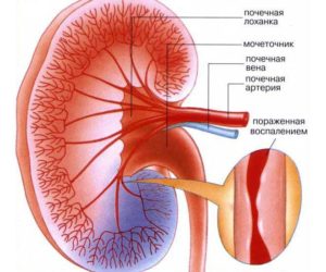 Нарушение кровообращения в почках симптомы