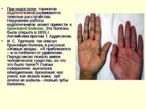 Не работают надпочечники симптомы