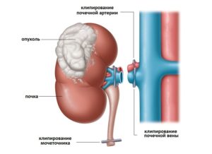 Нефрэктомия почки послеоперационный период диета