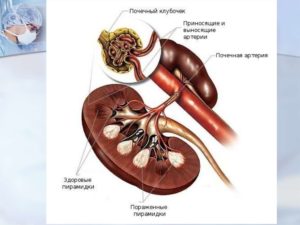 Нефромегалия что это такое