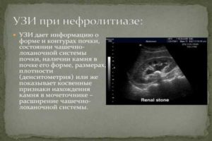 Нефромикролитиаз почек что это такое