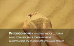 Нефромикролитиаз почек что это такое