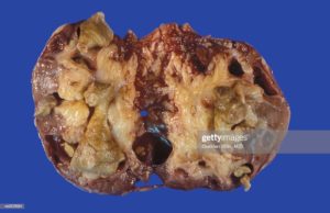 Нефромикролитиаз почек что это такое