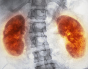 Нефромикролитиаз почек что это такое