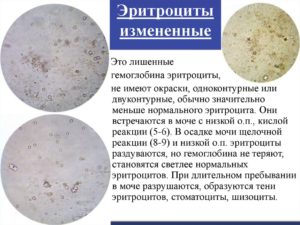 Неизменные эритроциты в моче что это значит