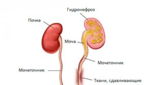 Обструкция в почке
