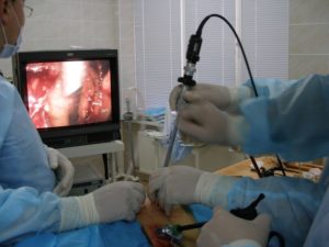 Операция по удалению камня из почки через мочеточник