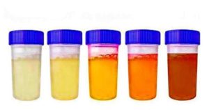 Определить заболевание по цвету мочи