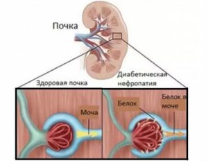 Осложнения на почки при сахарном диабете 2 типа
