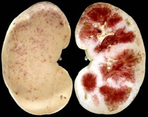 Острый геморрагический пиелонефрит