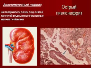 Острый геморрагический пиелонефрит