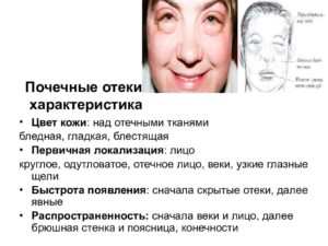 Отеки при почках лечение