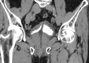 Парауретральная киста по 10 мкб 10