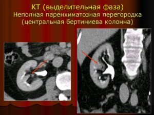 Паренхиматозная перемычка в почке что это
