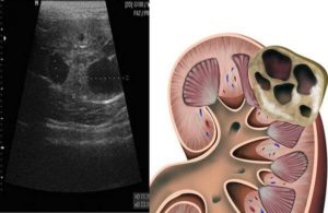 Паренхиматозный слой почки ниже нормы