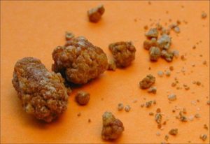 Первые признаки песка или камней в почках