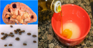 Песок в почках народное лечение