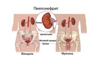 Пиелонефрит почек симптомы у мужчин