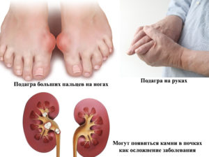 Почки суставы связь