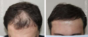 После пересадки почки выпадают волосы