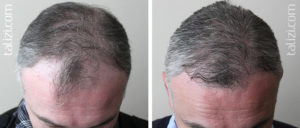 После пересадки почки выпадают волосы