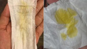 После родов моча пахнет