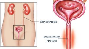 Последствия уретрита у женщин