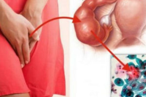 Последствия уретрита у женщин