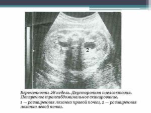 Расширение лоханки почек при беременности